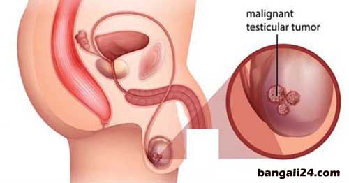 অন্ডকোষের রোগ ও চিকিৎসা অন্ডকোষের টিউমার