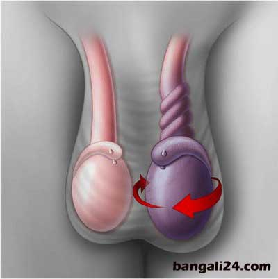 অন্ডকোষের রোগ ও চিকিৎসা অন্ডথলি ফুলে যাওয়া