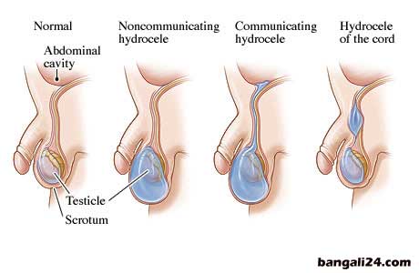 অন্ডকোষের রোগ ও চিকিৎসা হাইড্রোসিল