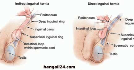 অন্ডকোষের রোগ ও চিকিৎসা হার্নিয়া