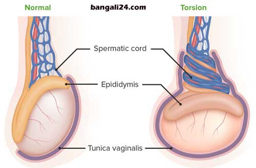অন্ডকোষের রোগ ও চিকিৎসা Testicular torsion
